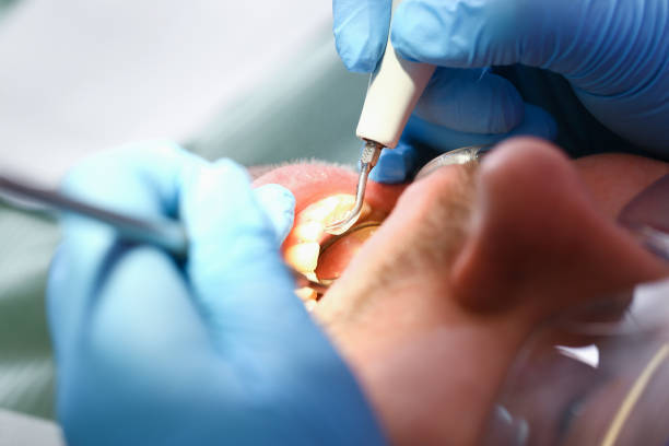 Best Emergency Root Canal Treatment in Cibolo, TX