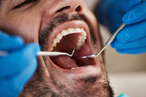 Best Emergency Wisdom Teeth Removal in Cibolo, TX